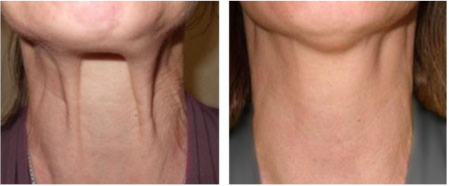 neck bands calgary botox neck rejuvenation treatment